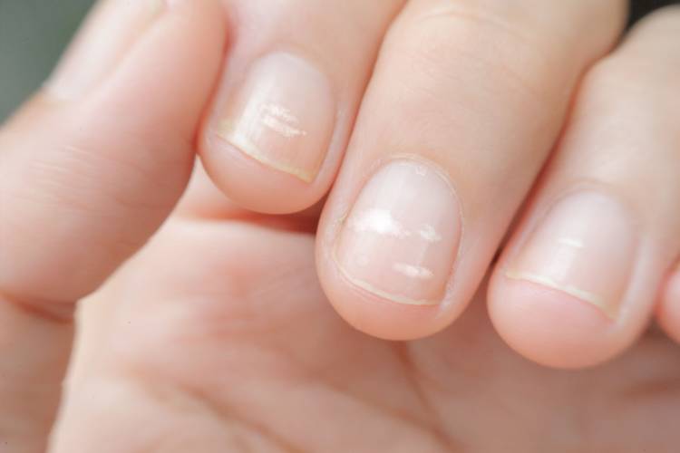 Why do white spots appear on nails? - Entrenosotros | Consum